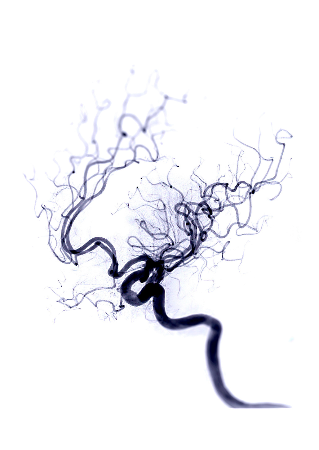Interventionsradiologie: Fluoroskopieaufnahme einer zerebralen Arterie.